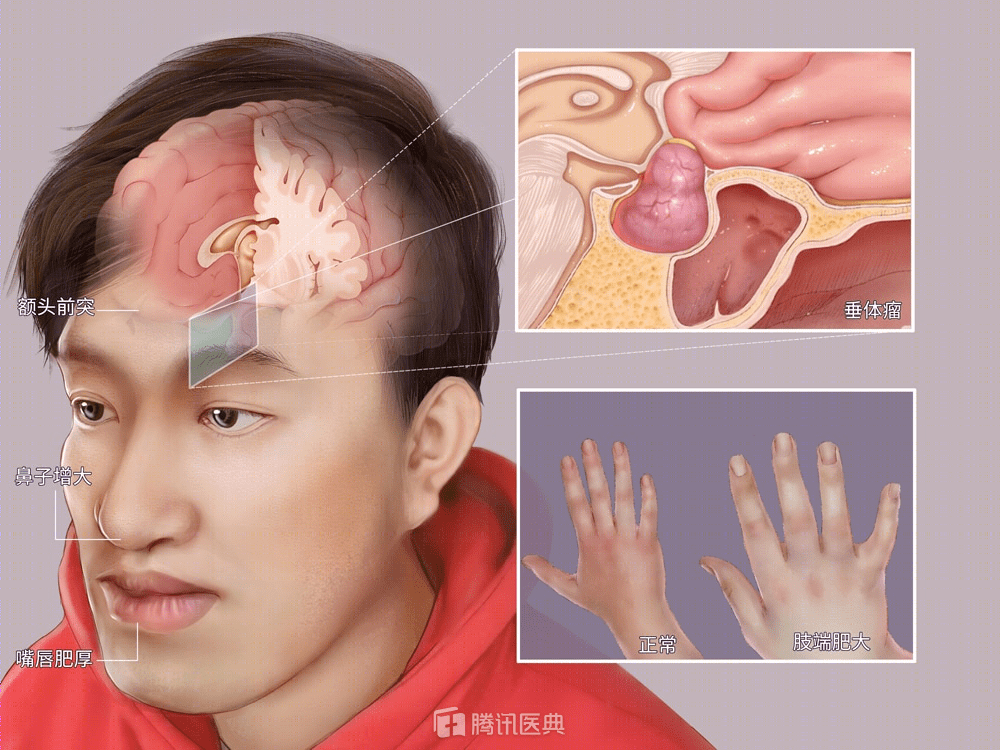 眉骨肿瘤图片