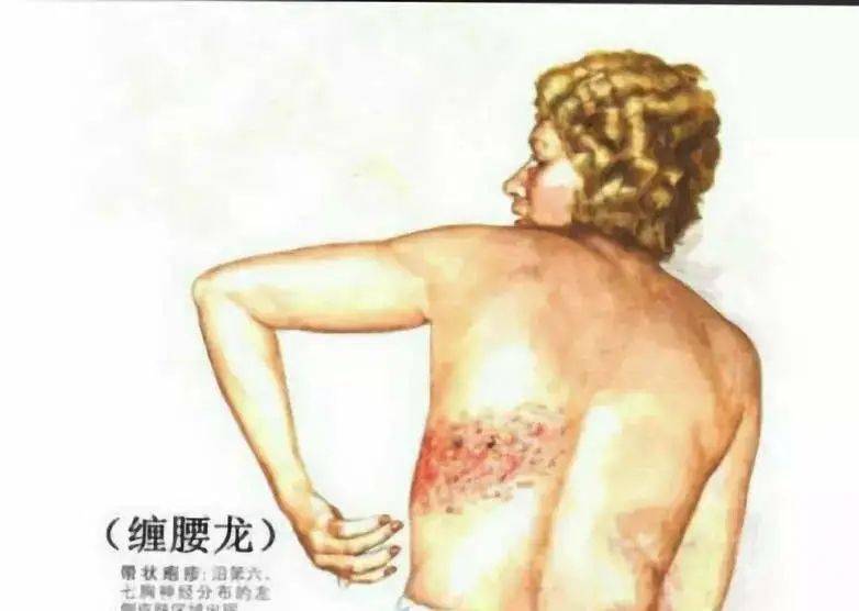 媒体视角浅谈带状疱疹后神经痛西北大学附属医院西安市