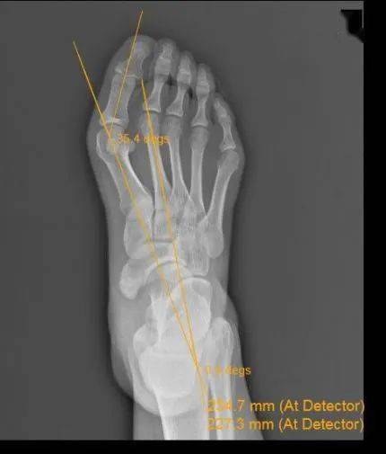 负重位x线片,籽骨切线位片准确测量外翻角度考虑到小丽的情况单纯地