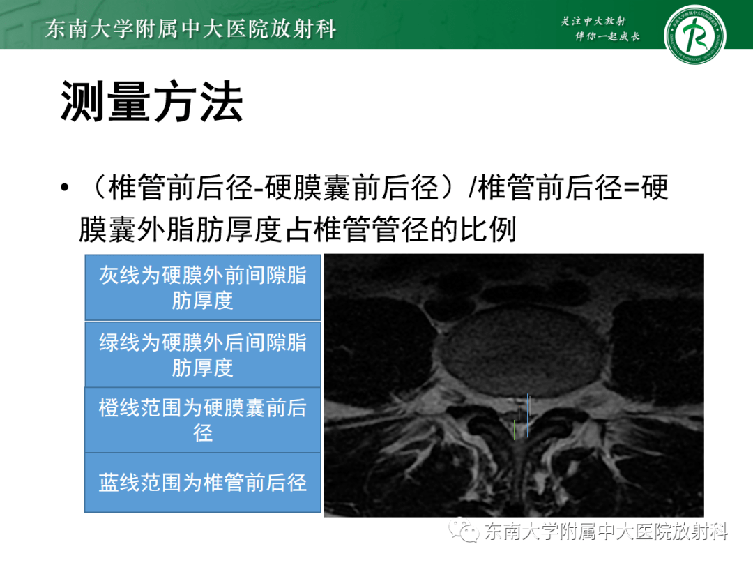 椎管内硬膜外脂肪增多症