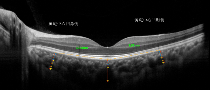 对侧眼黄斑中心凹下,距黄斑中心凹3mm鼻侧及颞侧注:图中红色箭头耸揪