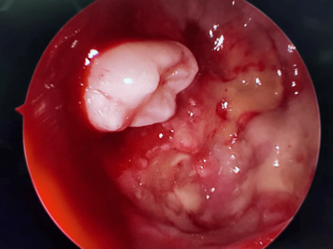 牙齿也会犯"调皮" "迷路"长到鼻窦里_吴坚_小伙子_二院
