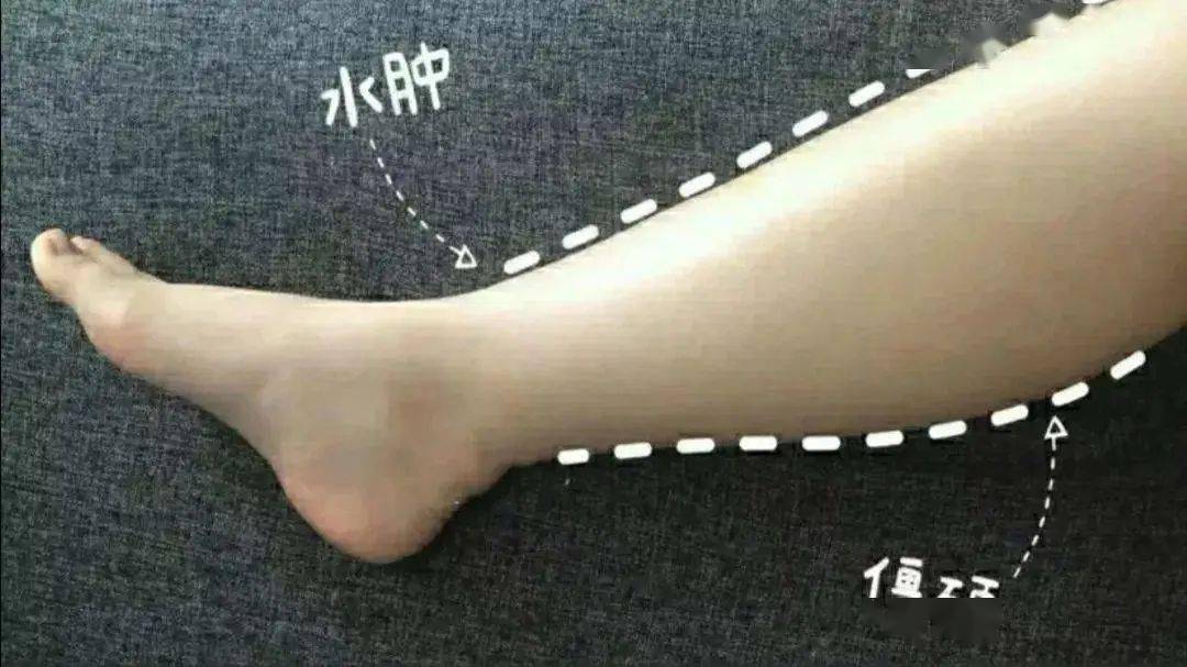 从而引发下肢可凹性水肿和腹水,逐渐向上蔓延,头,面部和上肢反而不会