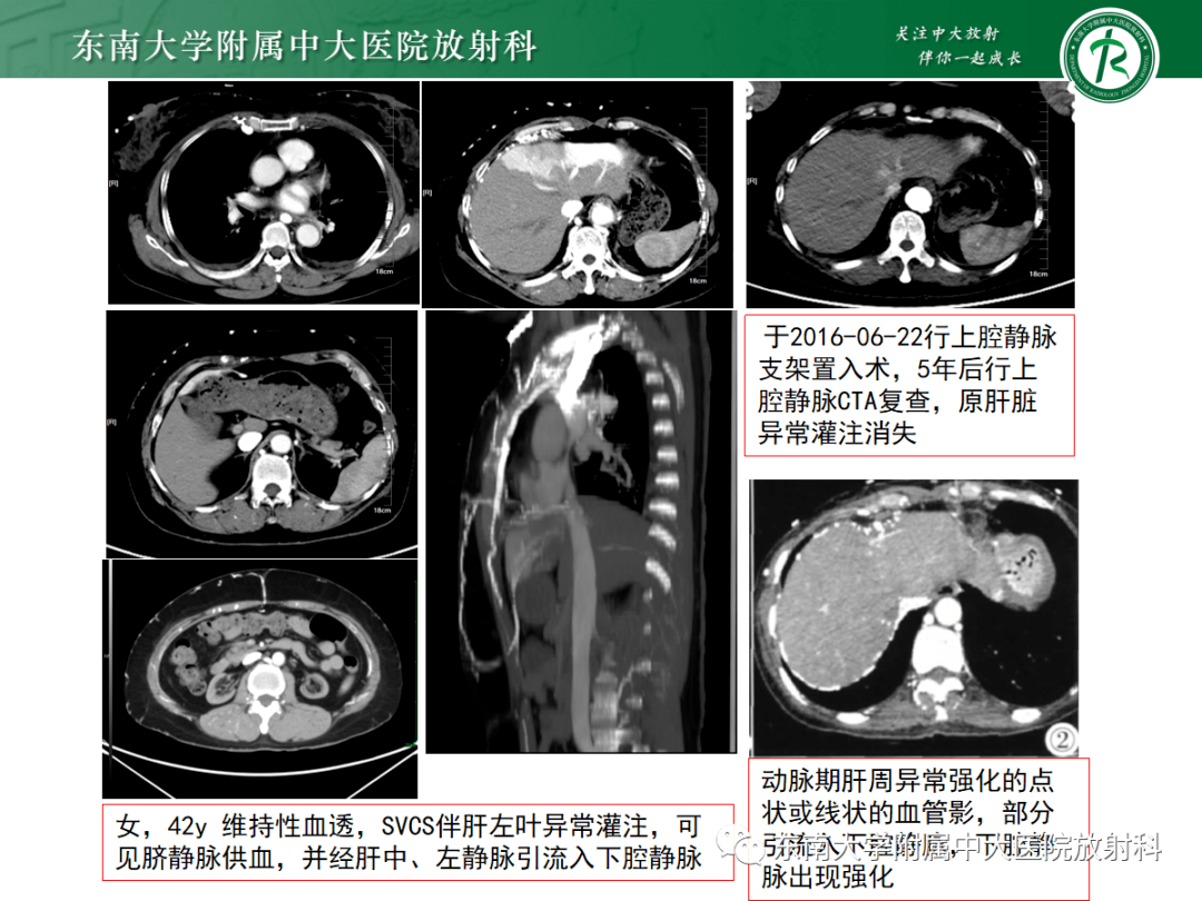 上腔静脉解剖图ct图片