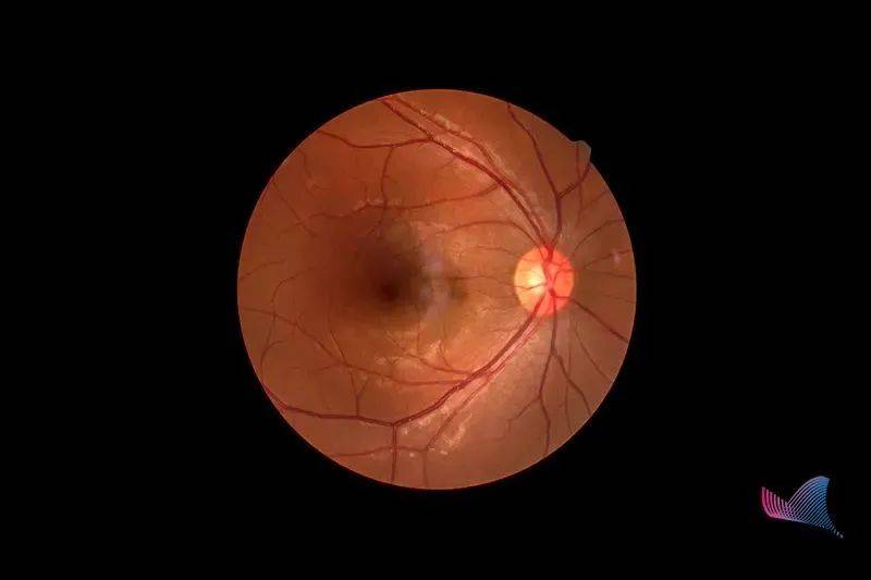 不要这样玩手机了,一男子因此视网膜脱离_患者_眼底_治疗