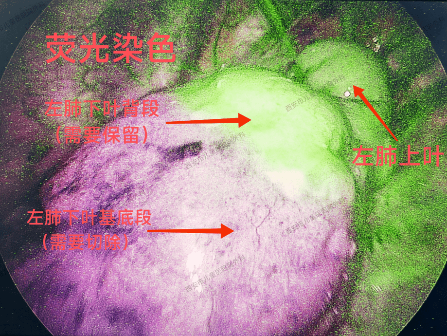 吲哚菁绿荧光胸腔镜下肺段切除术在我院顺利完成中国新闻网·2022-08