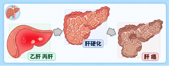 在我国,约有90%的肝癌患者感染过乙肝病毒;而在西方国家,感染丙肝病毒