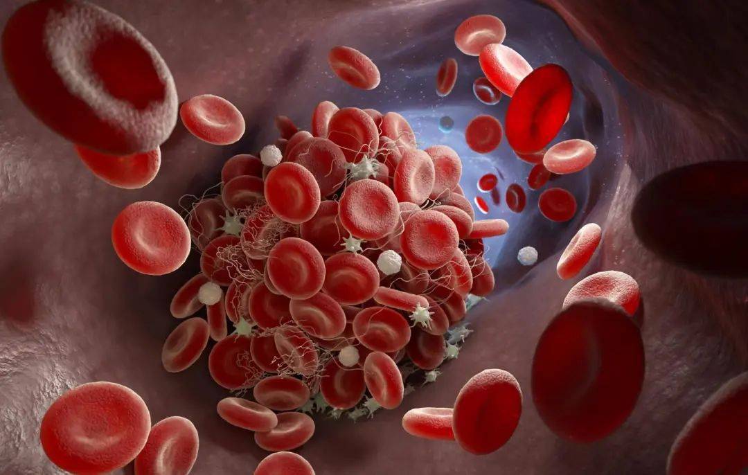 关爱"玻璃人" | 苏州明基医院"血友病之家"康复训练营圆满举行_患者