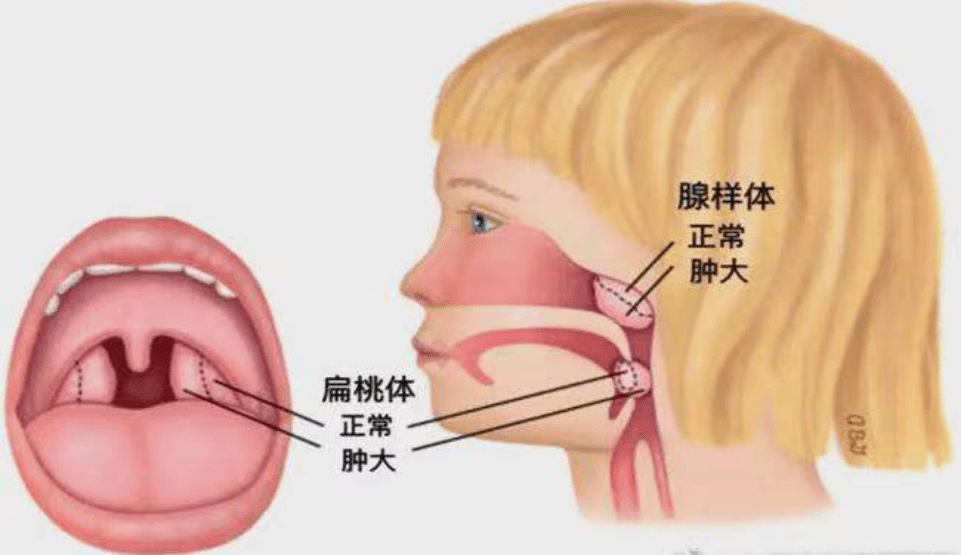腺样体又称咽扁桃体,为一团淋巴组织,类似口咽部的扁桃体,位于鼻咽顶