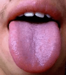 正常舌头侧面图片