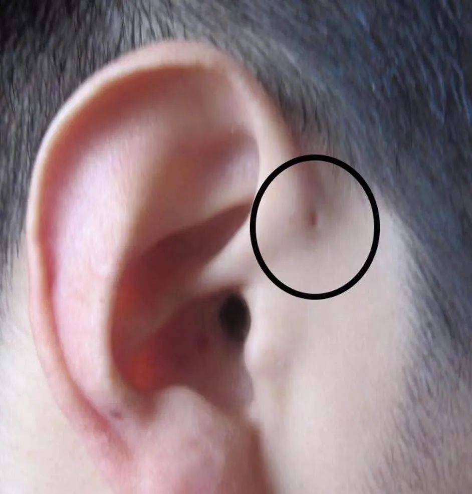 型耳前瘘管:没有症状,无需处理,但若为避免以后发生感染要求手术切除