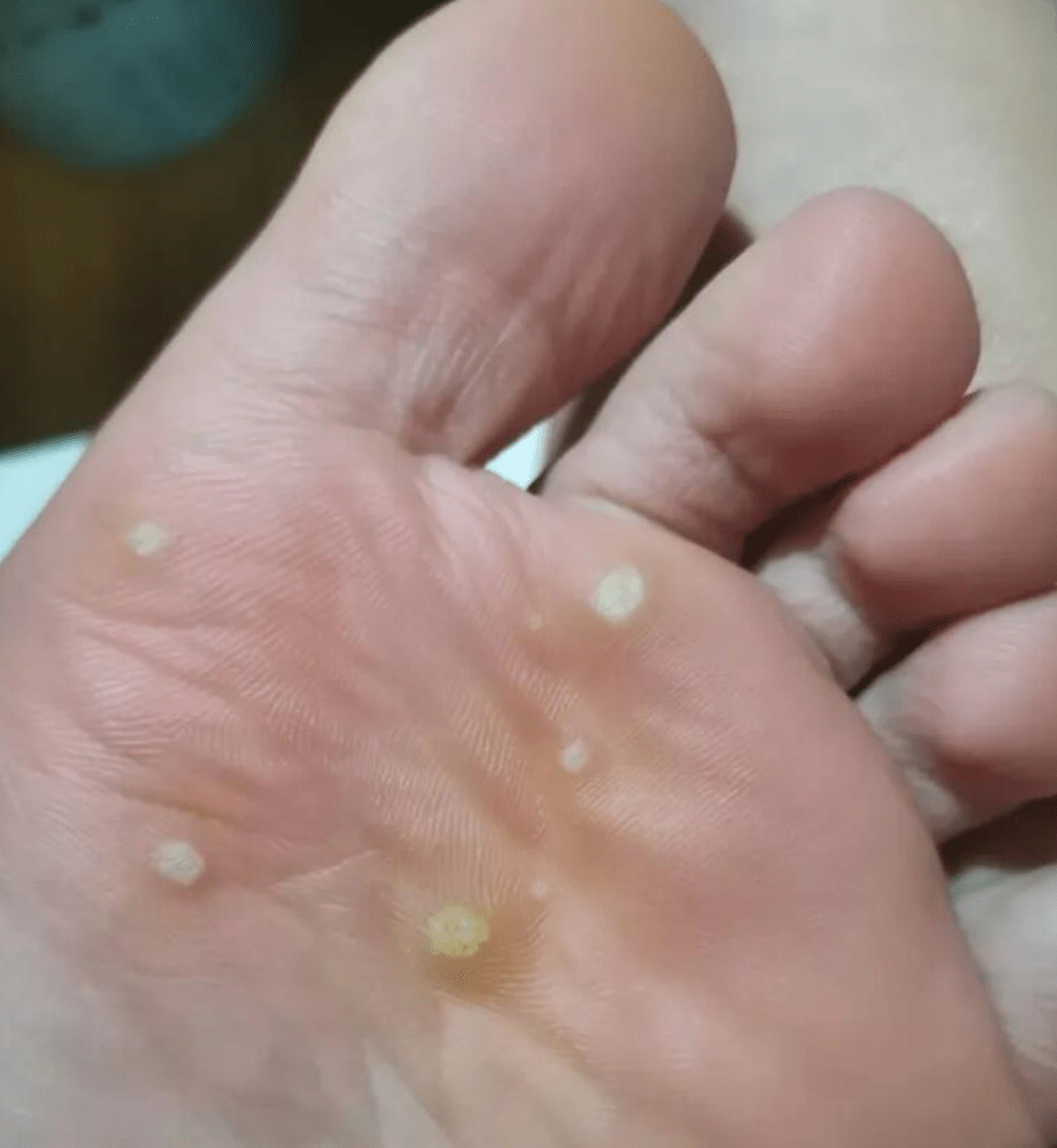 10岁男孩上游泳课脚底长满小疙瘩,医生:感染了hpv_建议_病毒_情况