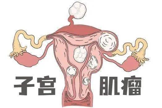 医德佳腺肌症保宫:当备孕遇到子宫肌瘤,能带瘤怀孕吗?