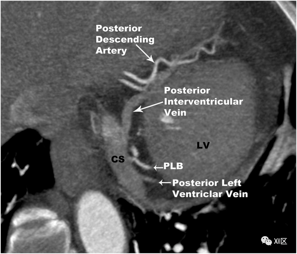 收藏!冠狀靜脈解剖與異常_veins_心臟_系統