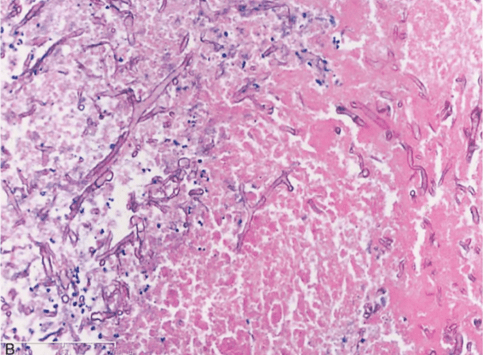 【衡道丨病例】肺麴黴菌病(pulmonary aspergillosis)如何診斷?