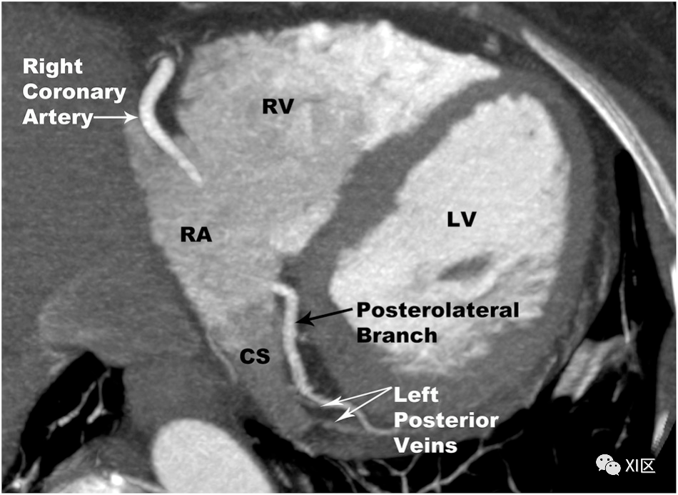 收藏!冠状静脉解剖与异常