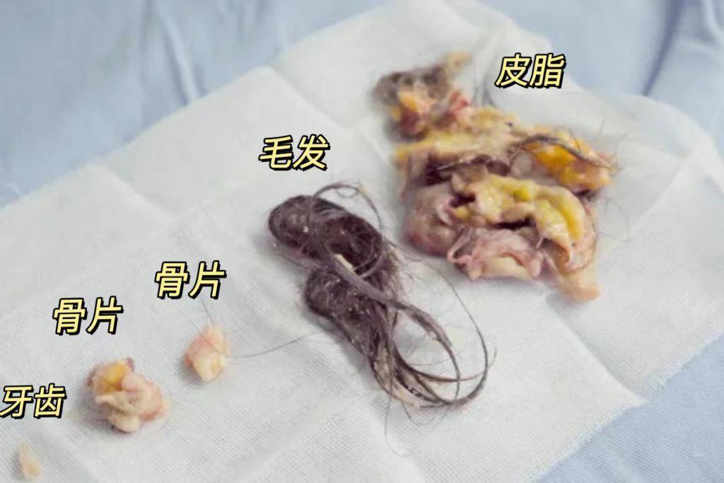 "不开刀不留疤"切除畸胎瘤,广州仁爱天河医院这技术牛!