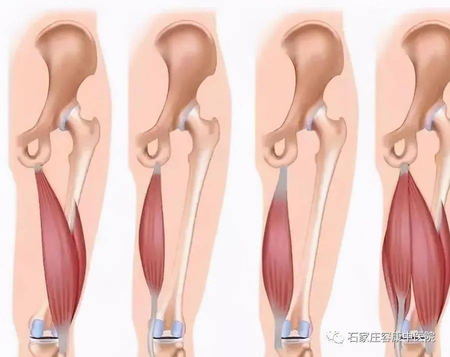 偏癱患者保護膝關節從預防膝過伸開始!_訓練_小腿_張力