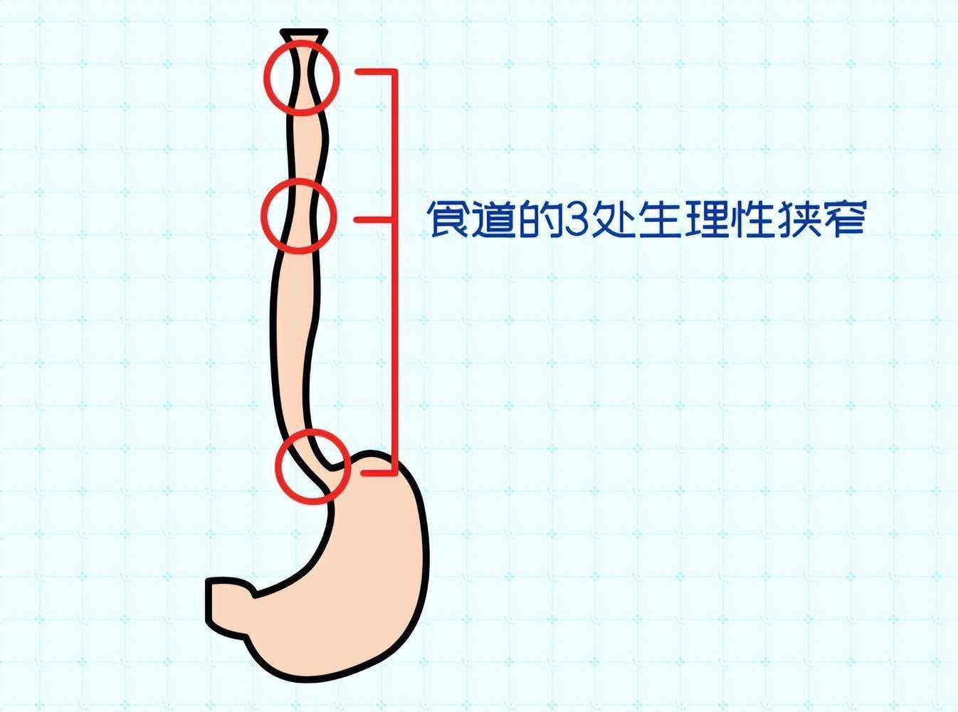 食管的第二个狭窄图片