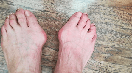 北京丰台广济医院科普:脚大拇指骨头突出是什么原因?