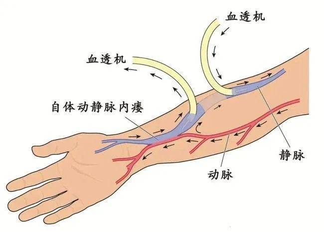 針壓瘻20分鐘後,一般針眼都不再出血,只是注意不要用有瘻側上肢提重物