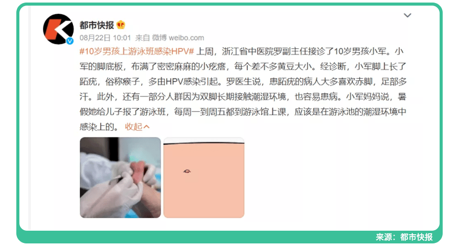 10岁男孩暑假上游泳班后,脚底长出小疙瘩,竟感染HPV！