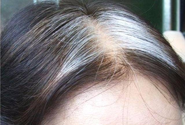 长在前额,两鬓,后脑勺,分别暗示什么_毛囊_长白_头发