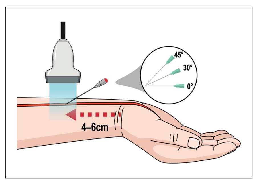 实用技术 | 桡动脉置管的 10 个最佳实践技巧_血管_导管_并发症