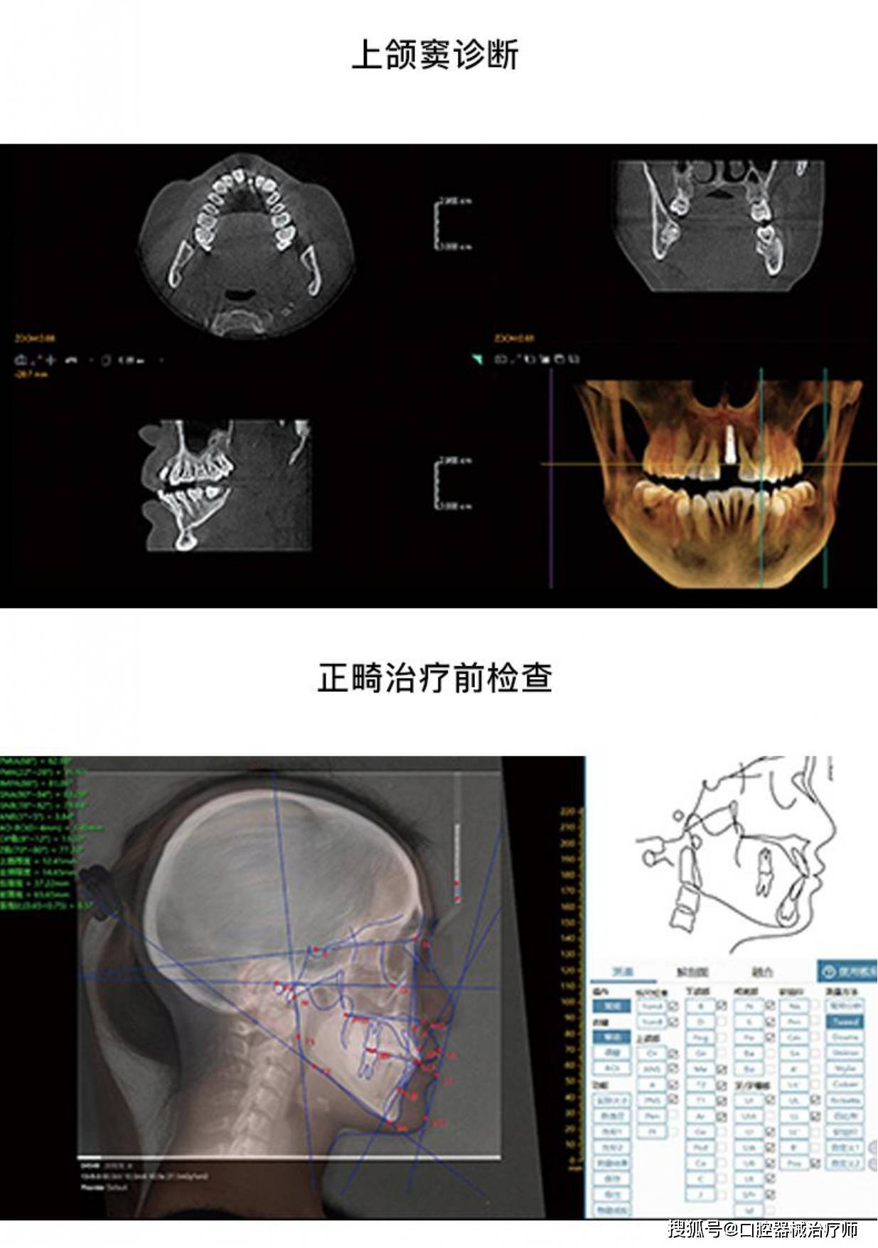 深圳菲森cbct