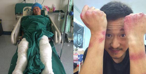 吴京粉丝制作受伤细节图 全身缝逾百针网友敬佩:武打明星快绝迹_成龙