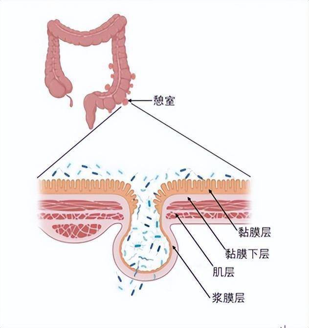 来自查:憩室病,结肠最常见的非癌性病变