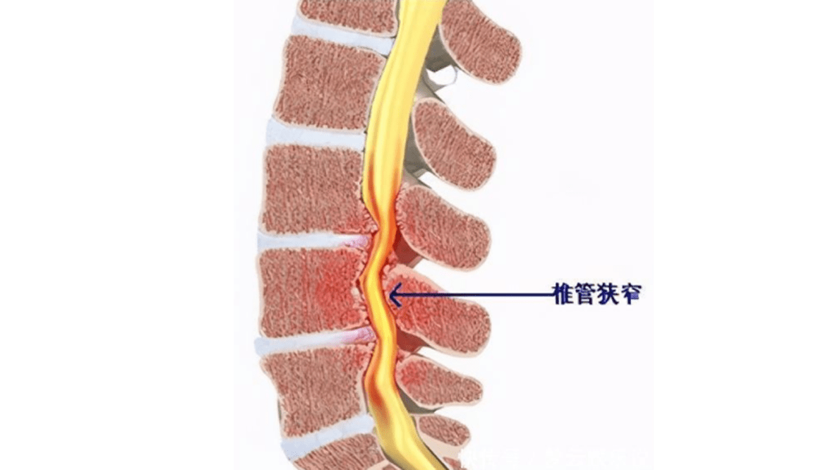 其实腰椎管狭窄症是可以达到临床上的治愈的