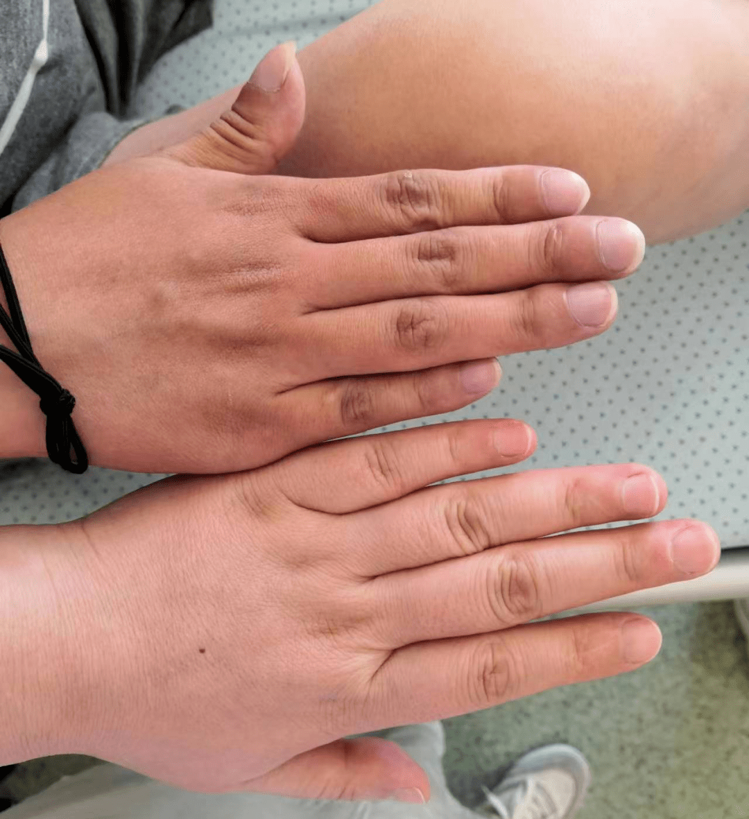 这种情况,可一定得做好措施!_小钱_艾森曼格_综合征