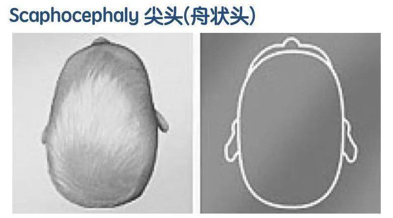 ①又窄又长—舟状头由先天性颅缝早闭导致的异常头型,家长们要重视