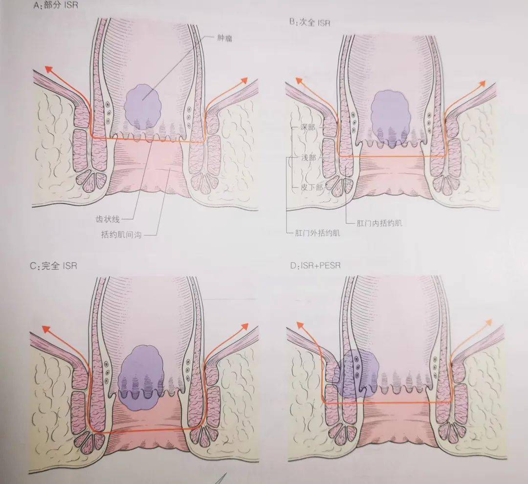 州医院普外三科挑战极限