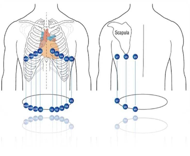 心电图5个电极位置图图片