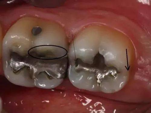 看到谁有"冰毒牙" 离他们远点!_牙齿_口腔_毒品