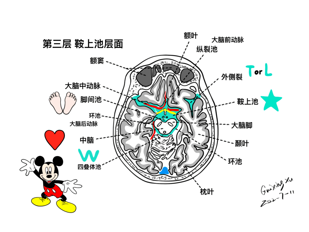 小脑蚓上池图片