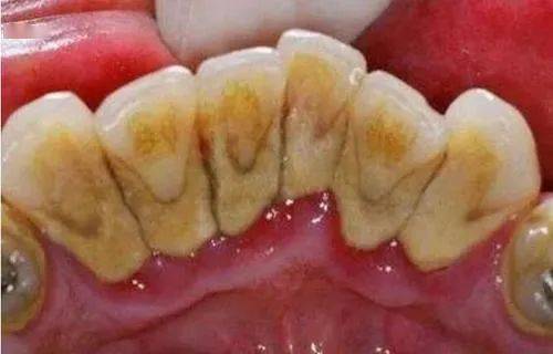 有一天突然掉了颗牙,才发现这个病已经很久了_牙齿_口腔_牙龈