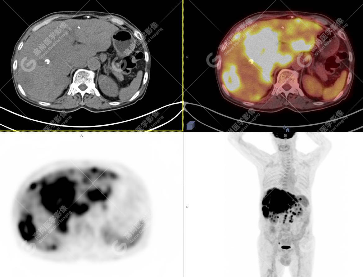 18F FDG PET CT 1 18f-fdg-pet-ct-1