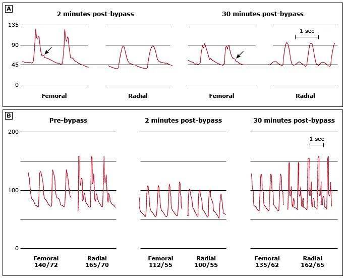 体外循环转流期间血压维持目标是多少？如何控制？