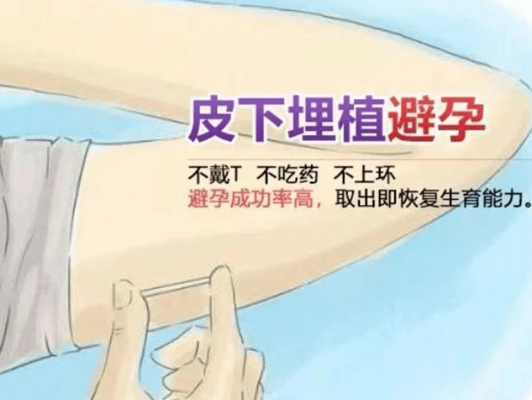 一针避孕三年——皮下埋植避孕攻略_同源_母婴_杂谈