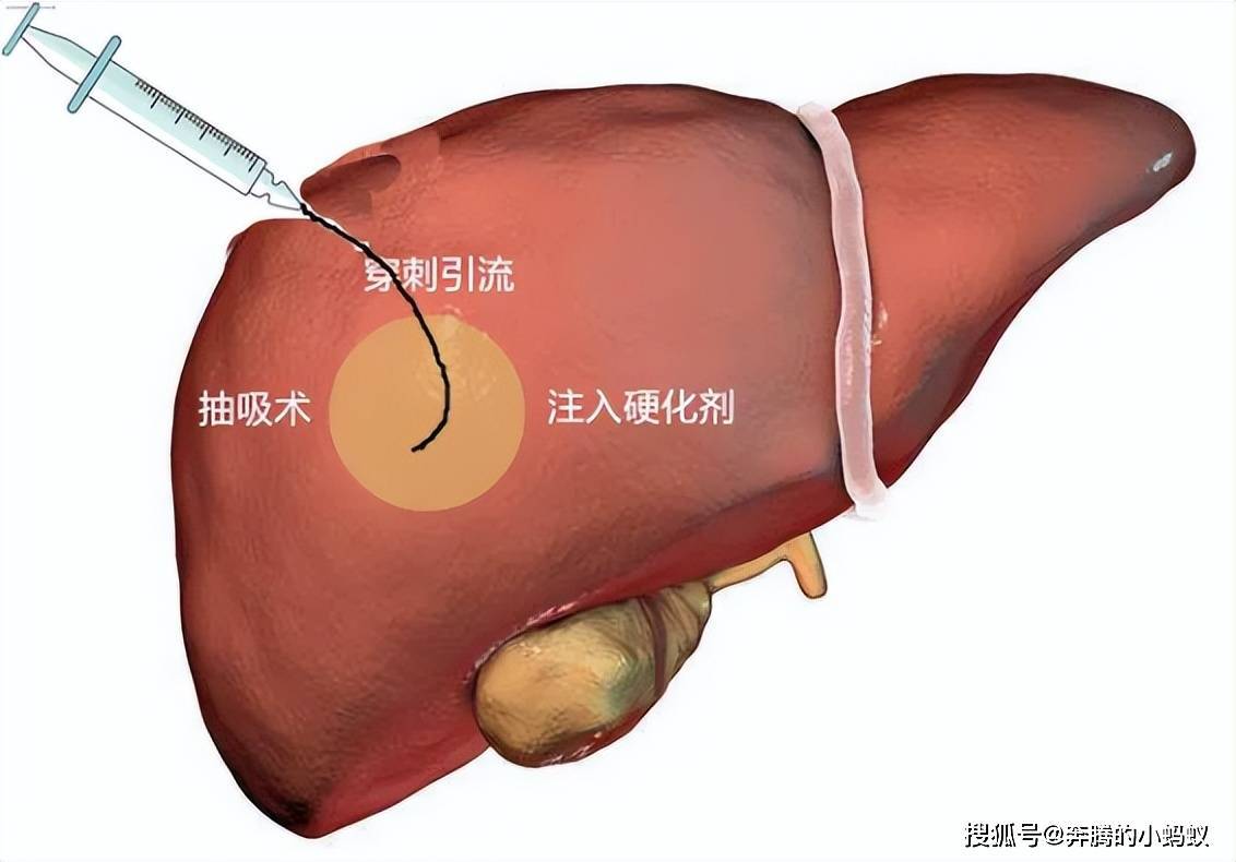 出现肝囊肿一定要动手术吗?医生是这样说的!_治疗_压迫_进行