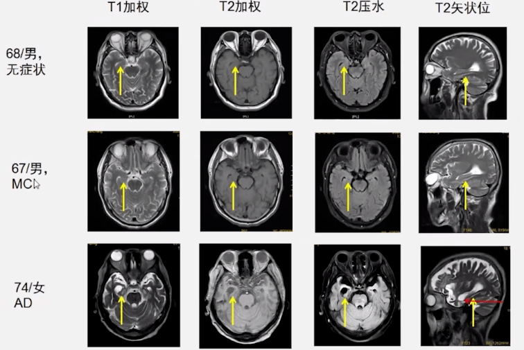老年性脑萎缩的影像学比较总结2.