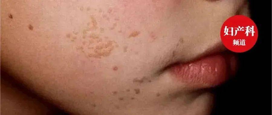 手上、脸上的疣哪些是HPV导致的?6种常见疣的区分和治疗_皮肤_表面_方法