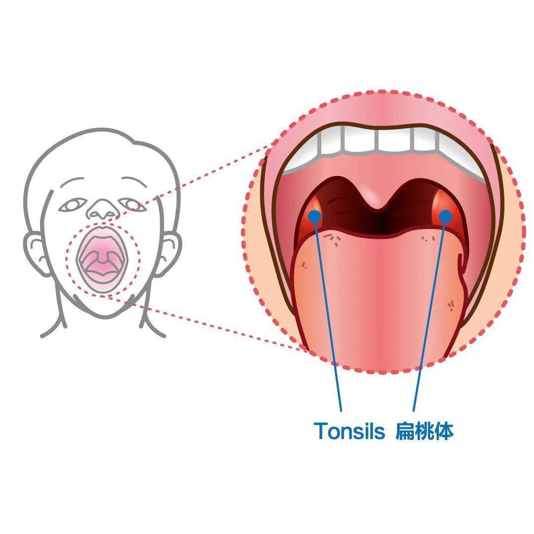 我们常吐槽的发炎君——扁桃体,指的是位于舌顎弓和咽顎弓腭之间的