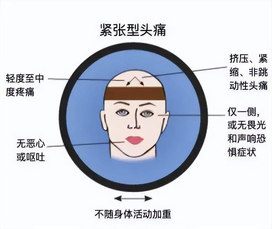 协和科普:偏头痛就是只有一边脑壳疼?关于偏头痛的问题一次说清