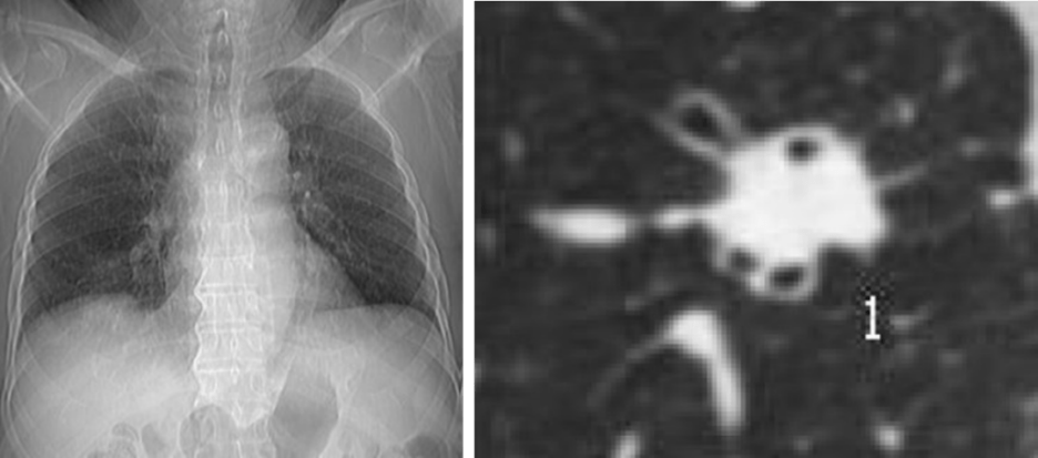 1年看上万张片子的医生透露：如何判断肺结节是不是肺癌？