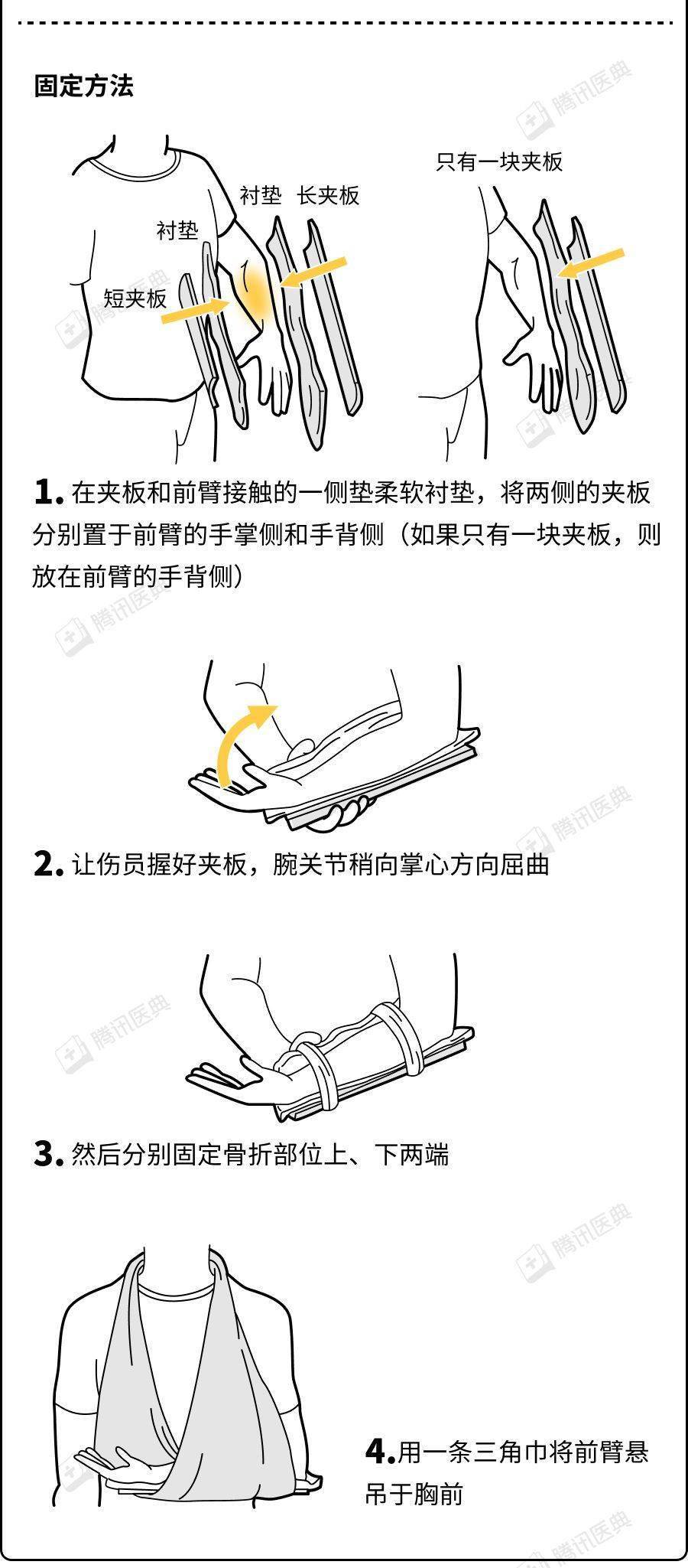 一图读懂骨折急救固定技术!