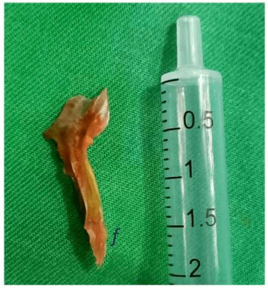 这群最会“挑刺”的医生,在写鱼刺论文了_异物_食管_刘宏